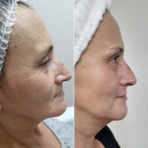 antes e depois tratamento facial