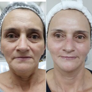 antes e depois tratamento facial.1